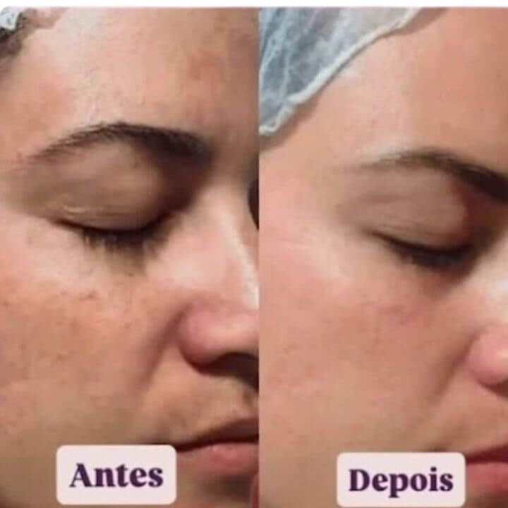 Antes e depois de limpeza de pele